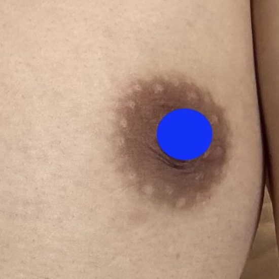 11日後皮むけ完了★のコピー