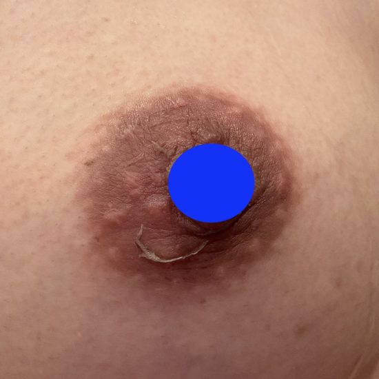 7日後皮むけ★のコピー